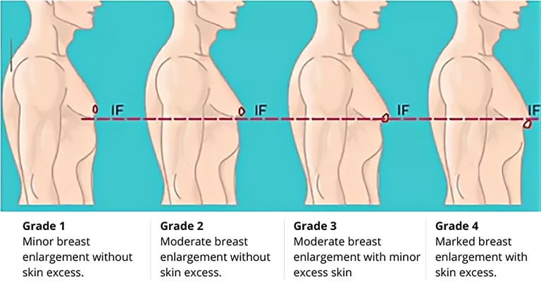 Classification of Gynecomastia